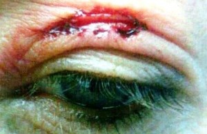 gouged eyelid